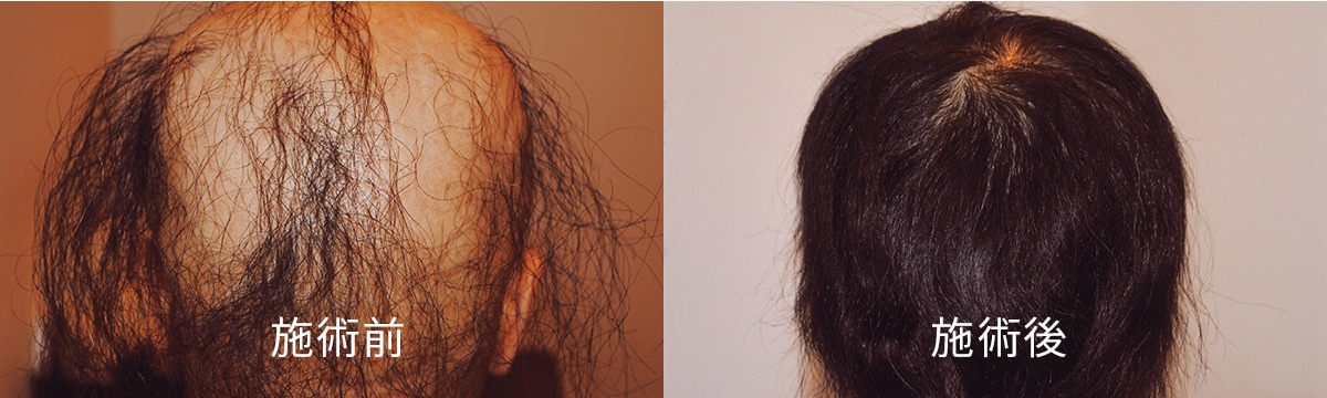 お客様の声 クリエーションヘアーズ 副作用のない女性の薄毛治療